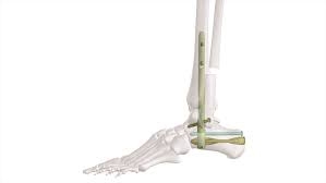 Global Ankle Fusion Nail Market Trends Driven by Aging Population