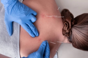 IMS and Dry Needling Therapy 
