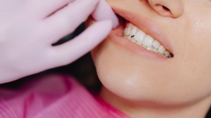 Simple Smile Fixes: Discover the Power of Composite Bonding 