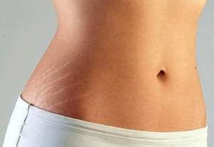 Do Stretch Mark Treatments Work on All Skin Texture?