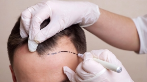 Revive Your Crown with Hair Transplant in Dubai