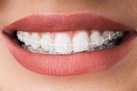 What Happens During a Braces Appointment?