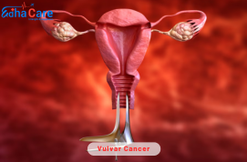 Comprehensive Vulvar Cancer Treatment in India with Affordable Options