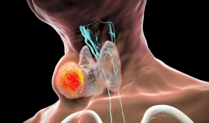 Medullary Thyroid Cancer Drugs Market Driven by Targeted Therapies