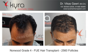 Understanding Hair Transplant Cost in India: What You Need to Know