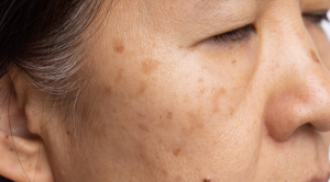 How Do Pigmentation Treatments Rejuvenate Skin?