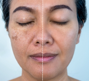 Who Is Most at Risk for Melasma?