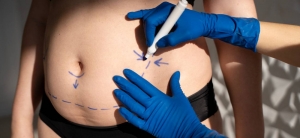 Liposuction in Dubai: Achieve Effortless Body Sculpting