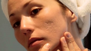 Acne Scars Treatment for Oily Skin in Islamabad
