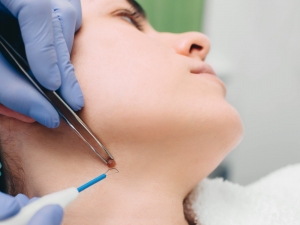 Can Raised Moles Be Removed Without Scars?