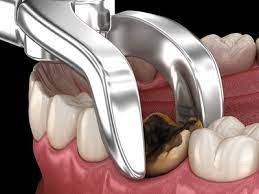 How to Prepare for a Wisdom Tooth Extraction?