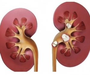 Ayurvedic Treatment For Kidney Stone: Natural Remedies to Dissolve and Prevent Stones
