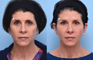 Why Choosing the Best Plastic Surgeon in Dubai Matters for Your First Botox Experience
