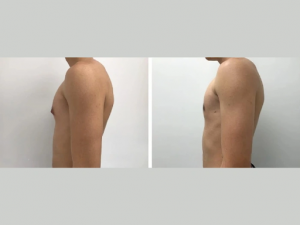 Understanding Gynecomastia: Causes, Symptoms, and Solutions in Dubai
