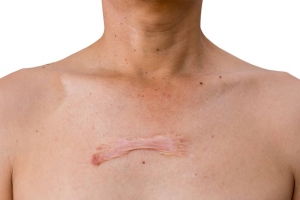 Common Causes of Keloid Scars
