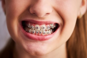 Braces Treatment Options at Local Orthodontic Clinics