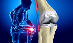 Joint Reconstruction Devices Market Flourishes by Aging Population