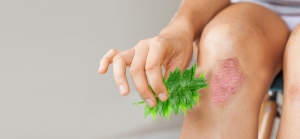 Radiation Dermatitis Treatment Market is in Trends by Rising Radiation Oncology Demand