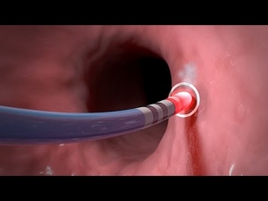 Cardiac Ablation Devices Market Estimated to Grow Owing to AI Catheter Navigation