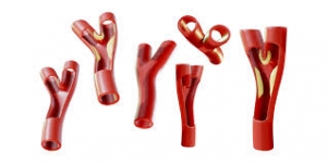 Peripheral Artery Disease Market to Surge with Drug-Coated Balloon Technology 