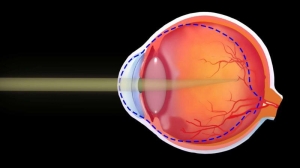 Presbyopia Treatment Market to Witness Growth with Innovative Therapies