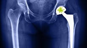 Hip Replacement in Lahore – Advanced Solutions for a Pain-Free Life