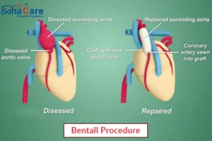 Advanced Heart Care at Affordable Prices: Bentall Procedure in India