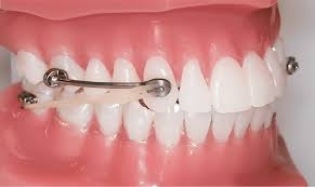 How to Clean Your Dental Appliance Safely?