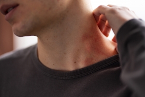 How to Identify Early Symptoms of Atopic Dermatitis