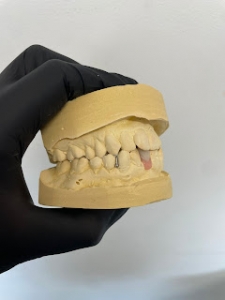 How Emergency Dentures Can Help You Smile Again in an Emergency