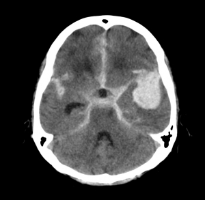 Intracranial Hemorrhage Diagnosis Market is in Trends by Market Growth