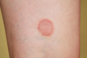 Lichen Planus Market Set to Soar with Biologics Advances