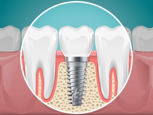 Do Dental Implants in Dubai Look and Feel Like Real Teeth?