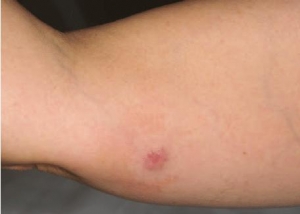 Merkel Cell Carcinoma Market Gains from Immuno-oncology Therapies