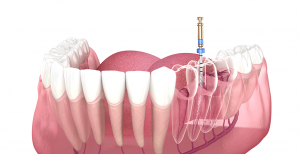 Are You Ignoring Root Canal Symptoms?