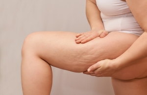 Does cellulite go away when you get toned?