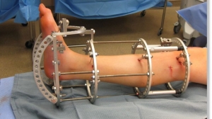 Limb Lengthening Surgery: What It Is, and Why Some People Choose It