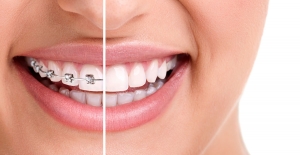 Straighten your Smile with the Elite Cherry Hill Braces