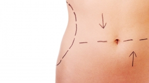 How Surgeons Customize Tummy Tuck in Islamabad