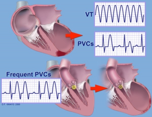 What to Expect Before, During, and After PVC Ablation