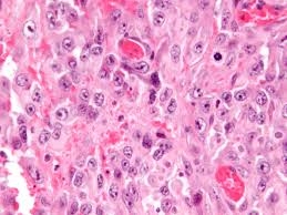 Epithelioid Sarcoma Market Outlook and Growth Strategies