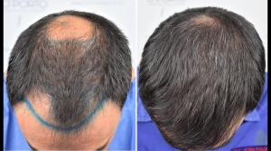What Happens on the Day of Your Crown Hair Transplant?