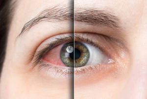 Digital Eye Strain vs. Dry Eye: What’s the Difference?
