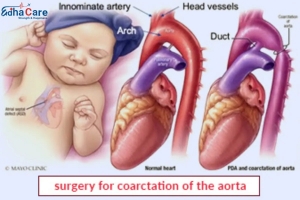 Advanced & Affordable Care for Coarctation of the Aorta in India