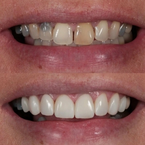 Can You Remove Stains from Composite Bonding?
