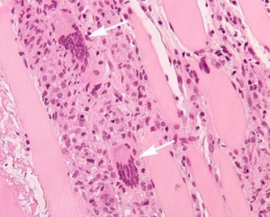 Evolving Inflammatory Myositis Diagnosis Market Outlook 2025-2032