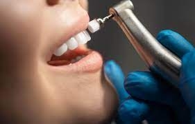 Should I Get Teeth Polishing If I Brush Daily?