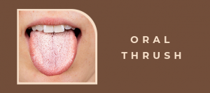 7 Facts About Oral Thrush That Everyone Should Know