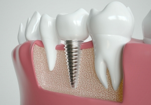 Look Great, Feel Amazing with Dental Implants in Dubai