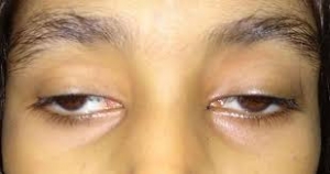 Global Ophthalmoplegia Market Outlook and Growth Trends